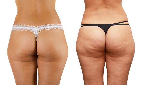 cellulite-2